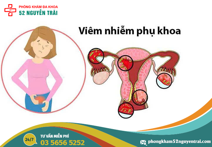 viem-nhiem-phu-khoa-la-gi